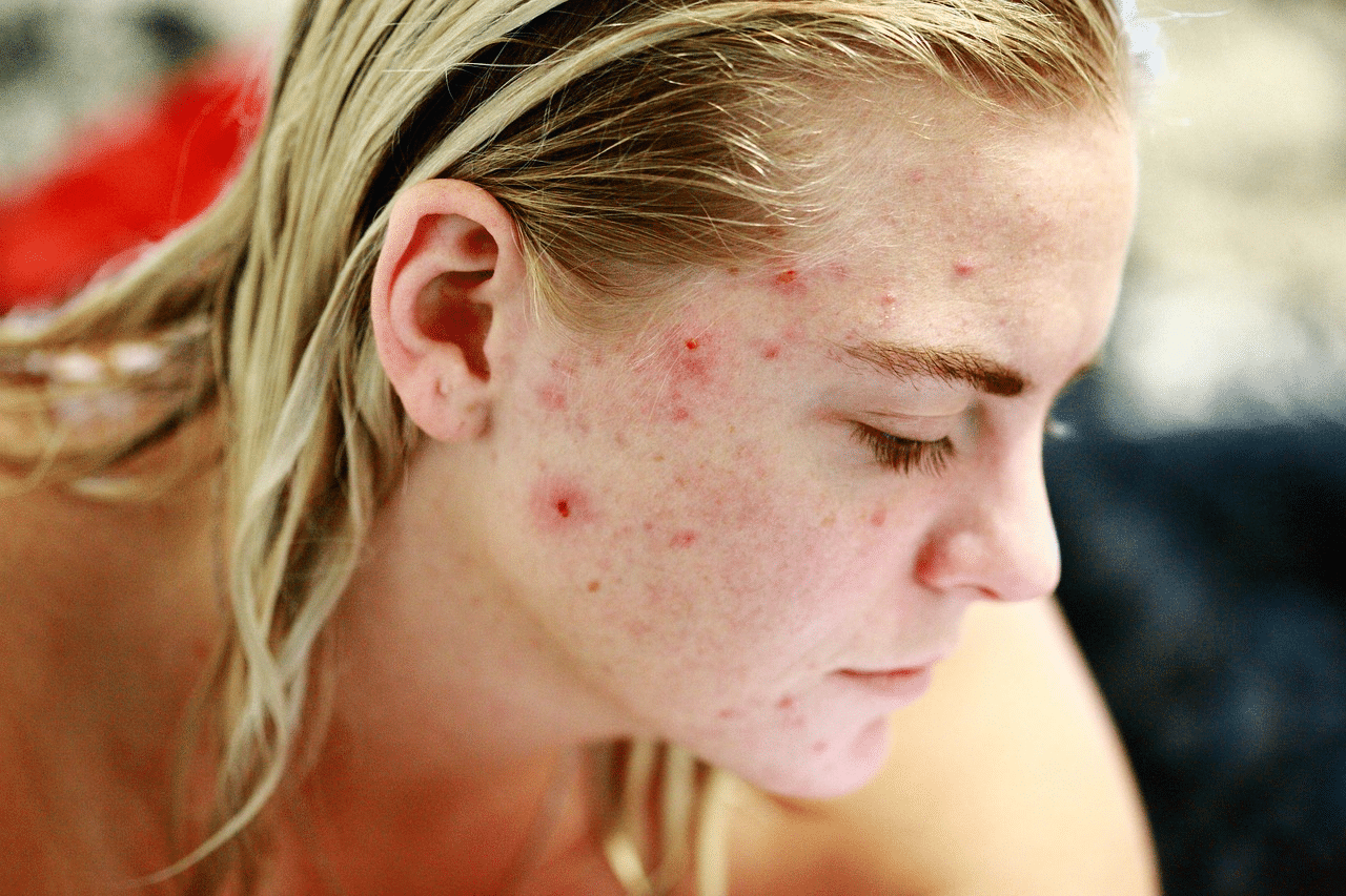 acne on face.